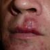 Why papules appear in the mouth and how to distinguish them from syphilis Chancre in the sky in the mouth