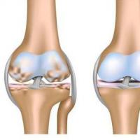 ДОА колінних суглобів: стадії, симптоми та лікування