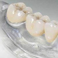 Proteze dentare flexibile: design, caracteristici și beneficii Varietăți de proteze moi cu fotografii